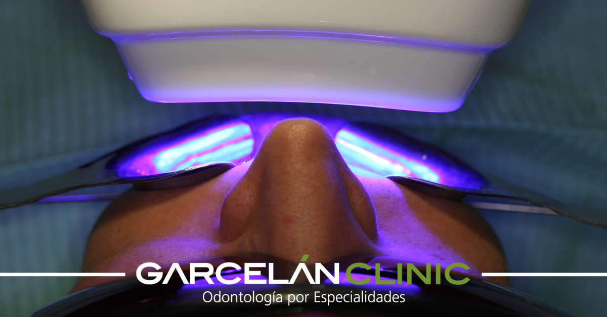 GarcelanClinic's tweet photo. ¿Tienes dudas sobre el #BlanqueamientoDental? Es un tratamiento muy común, pero sobre el que hay mitos que conviene despejar: https://t.co/idNE1lhu8J https://t.co/ctRNQTsmeA