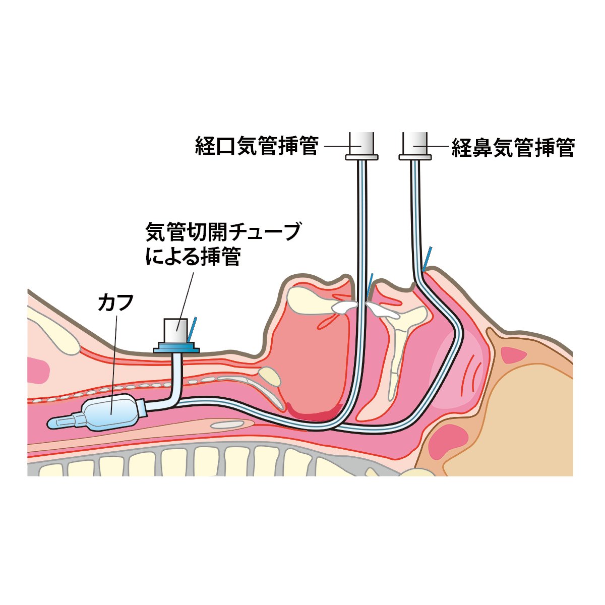 人工呼吸器と酸素マスクの違いをわかりやすく解説する画像 Togetter