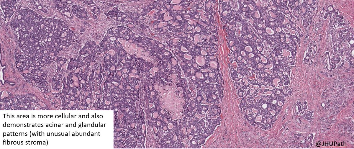 Histology Briseán Cealla Acinar Primary Pure Pancreatic Type Acinar