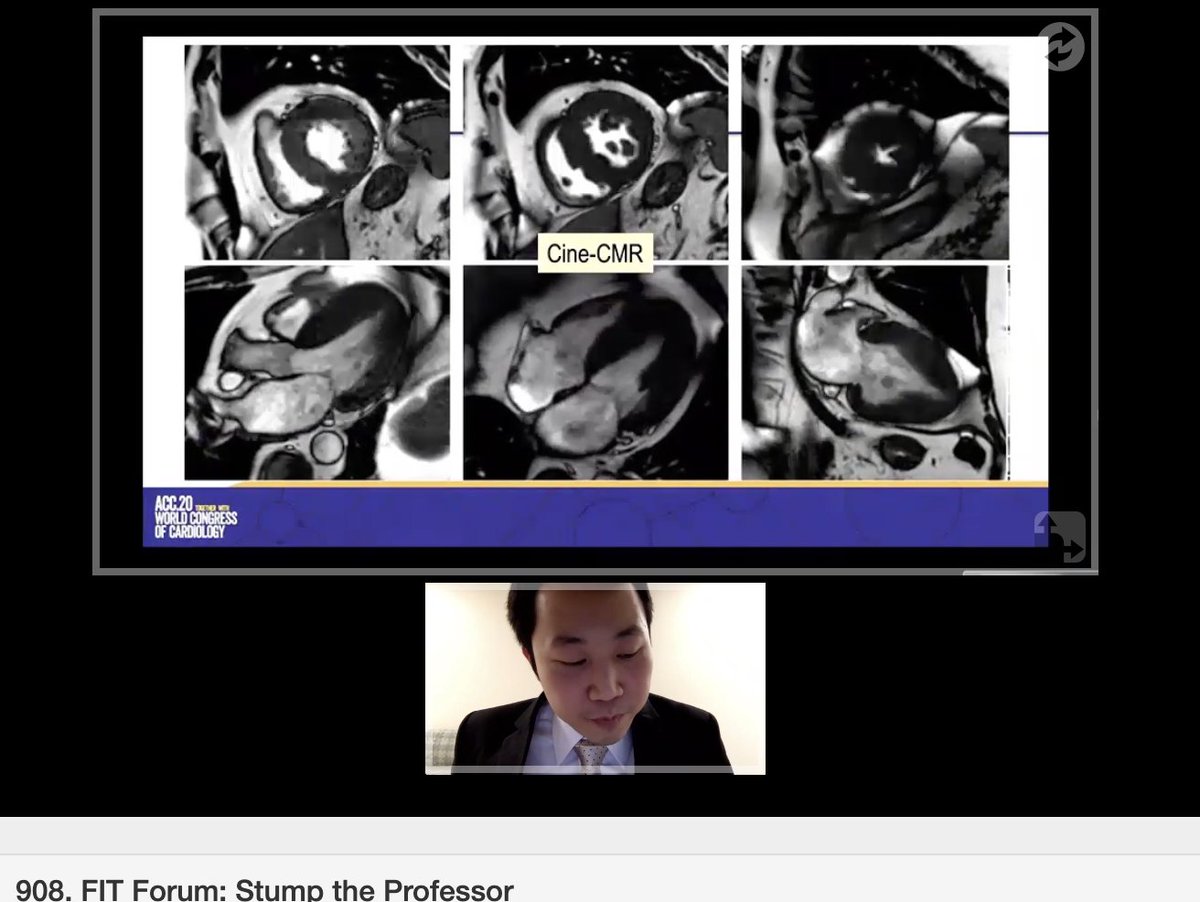 DoctorLatina's tweet photo. Dr. Yodying Kaolawanich presenting case3β£ for #StumpTheProfessor #ACCFIT #ACC20 sounds like a typical patient initially... but further imaging with #echo #echofirst and then #CMR #whyCMR was very helpful for diagnosis! Always think amyloid! @SCMR @ACCinTouch @worldheartfed https://t.co/qxVDHhwdat
