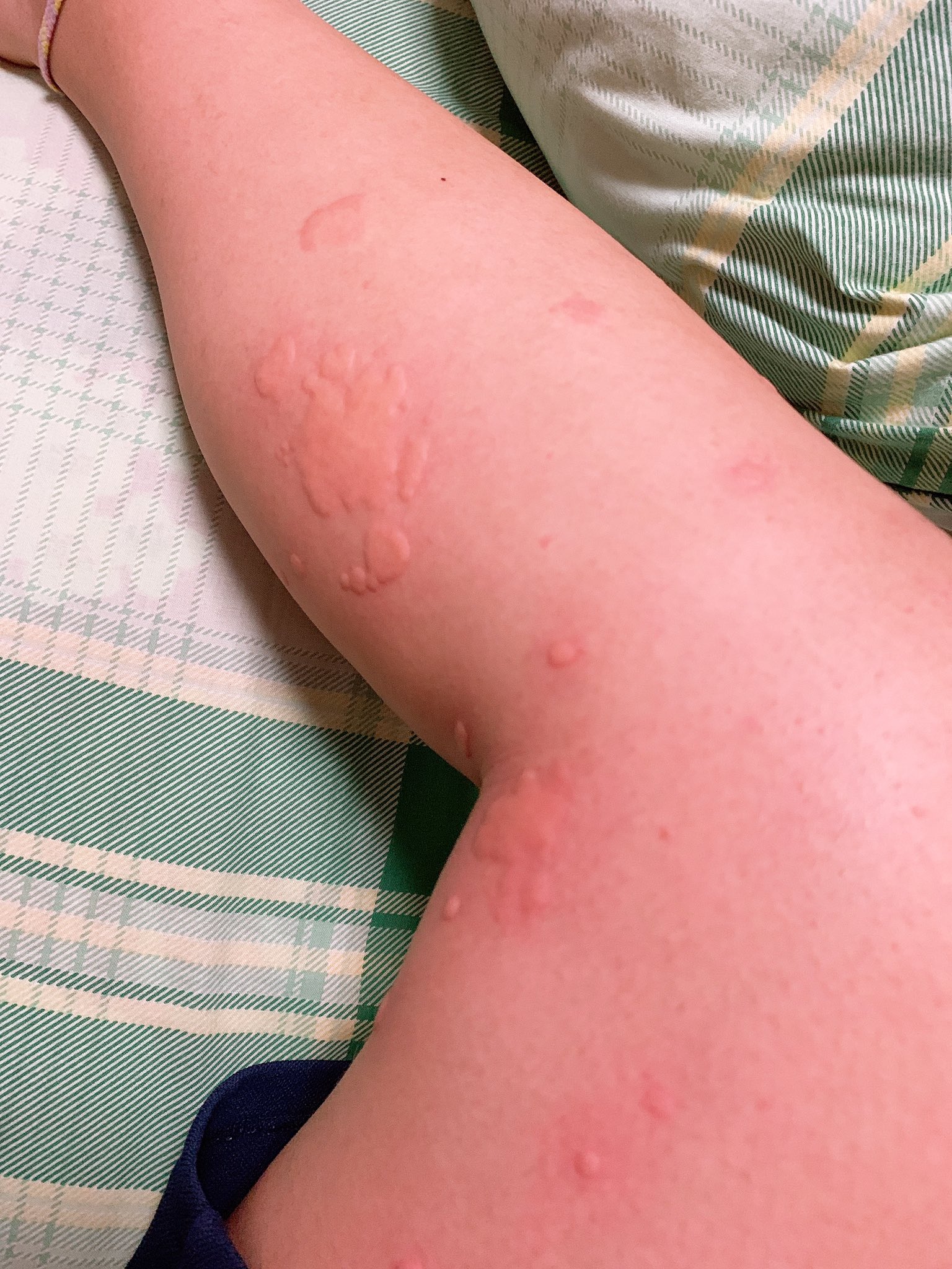 三好佑依 On Twitter: "朝一から熱出るわ、吐き気酷いわ、頭痛酷いわでめっちゃしんどいのに、 今になって両腕、両足に蕁麻疹て…  しんどすぎる。 Https://T.co/Obupn2Hpsm" / Twitter