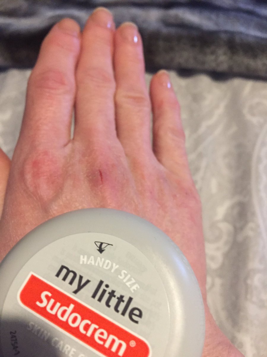 gerflynn2010's tweet photo. Good old @sudocrem to the rescue!! Layer it on go to bed .... relief......go to work repeat and wait for days off!!!!! #nurseshands #WashYourHands #nhsandproud https://t.co/ShBYHDMqvg