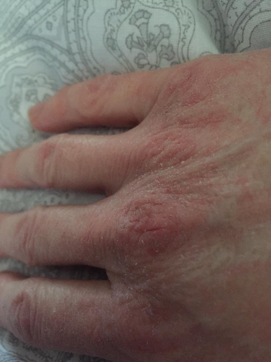gerflynn2010's tweet photo. Good old @sudocrem to the rescue!! Layer it on go to bed .... relief......go to work repeat and wait for days off!!!!! #nurseshands #WashYourHands #nhsandproud https://t.co/ShBYHDMqvg