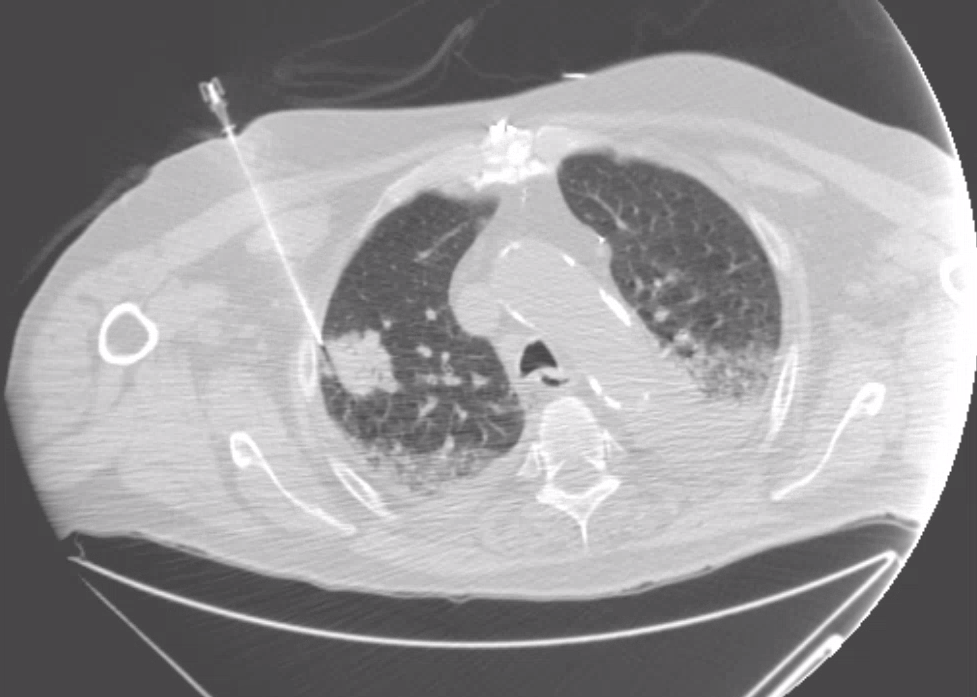 urmed_ir's tweet photo. 79 yo M with progressive SOB. Found to have a RUL mass. #BasicIR CT guided biopsy to confirm the suspicion of adenocarcinoma. Just another of the many ways #Irad can help our #oncology colleagues.

#WithoutAScalpel #TwittIR #RadTwitter #Interventional #Radiology #InnovationToHeal https://t.co/wtxxuzx5Cl