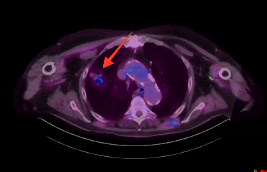 urmed_ir's tweet photo. 79 yo M with progressive SOB. Found to have a RUL mass. #BasicIR CT guided biopsy to confirm the suspicion of adenocarcinoma. Just another of the many ways #Irad can help our #oncology colleagues.

#WithoutAScalpel #TwittIR #RadTwitter #Interventional #Radiology #InnovationToHeal https://t.co/wtxxuzx5Cl
