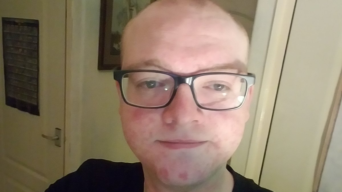 DanAmesYT's tweet image. So we hit our charity donation goal for @KidneyFund and I said I would honor all challenges!

You may have already seen the Bertie Botts video. (previous tweet) All that's left was the beard and hair shave. Hi... Uhm I'm Cupid... And I don't look 40 anymore 

#FightingOnAllFronts