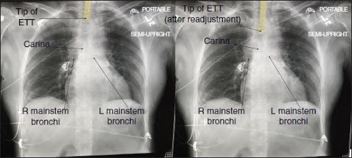 Placement: Post intubation you should get an X-ray. You want to make sure that the ETT is 5cm (+/-2) above the carina. This is a guideline ; ideal placement may vary. (Pic from Dr. Google)