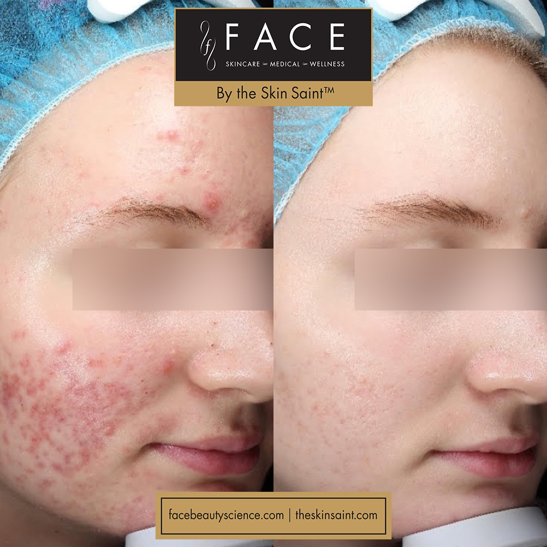 FaceMedical's tweet photo. Our office might be temporarily closed, but you can still achieve healthy, glowing 🌟 skin by using our products sold by The Skin Saint. (See before and after below). We’re also offering 20% off all products and virtual consults. Shop here: https://t.co/lFQDHHZ8Zv https://t.co/qZ9uhxiHfp