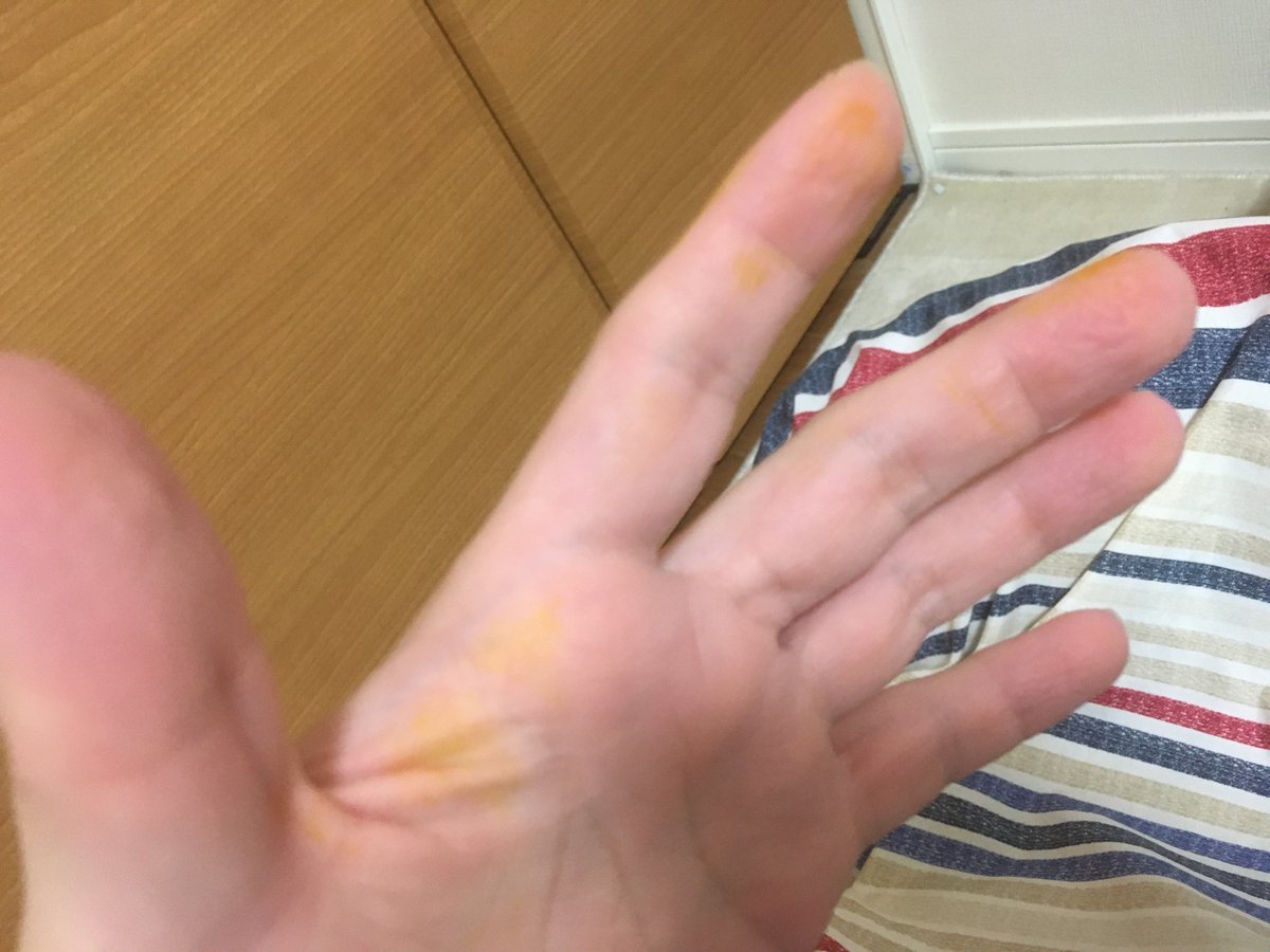 ユウちゃん う うわあああ 手が 手が黄色い これは肝臓が悪い時に現れる症状 ってよくみたらお前か犯人は 携帯に貼ってたやつやわ