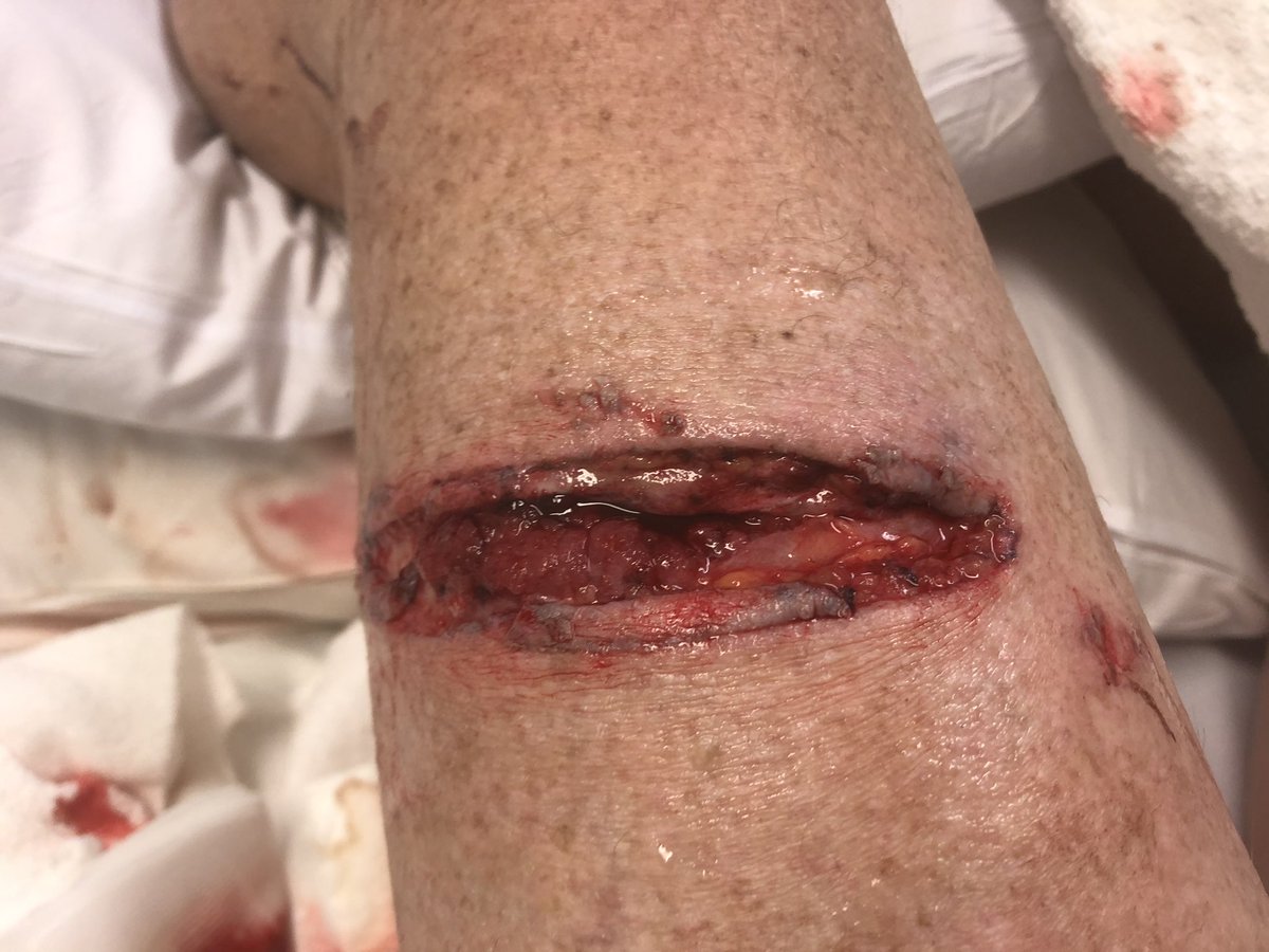 Found a good reason to stay at home for a couple of weeks but it’s not for everyone. Hint is ( chainsaw)