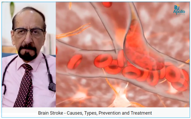 DrPNRenjen's tweet photo. There are two types of strokes- #Ischemicstroke & #Haemorrhagic Stroke. The first one is caused by a clot in the brain with decreased blood supply.
Learn more: https://t.co/hrX4gFMCro
#cerebralstroke #Neurologist #Stokespecialist #preventstroke #strokeneurology #TypesOfStrokes https://t.co/rqOGI2164M