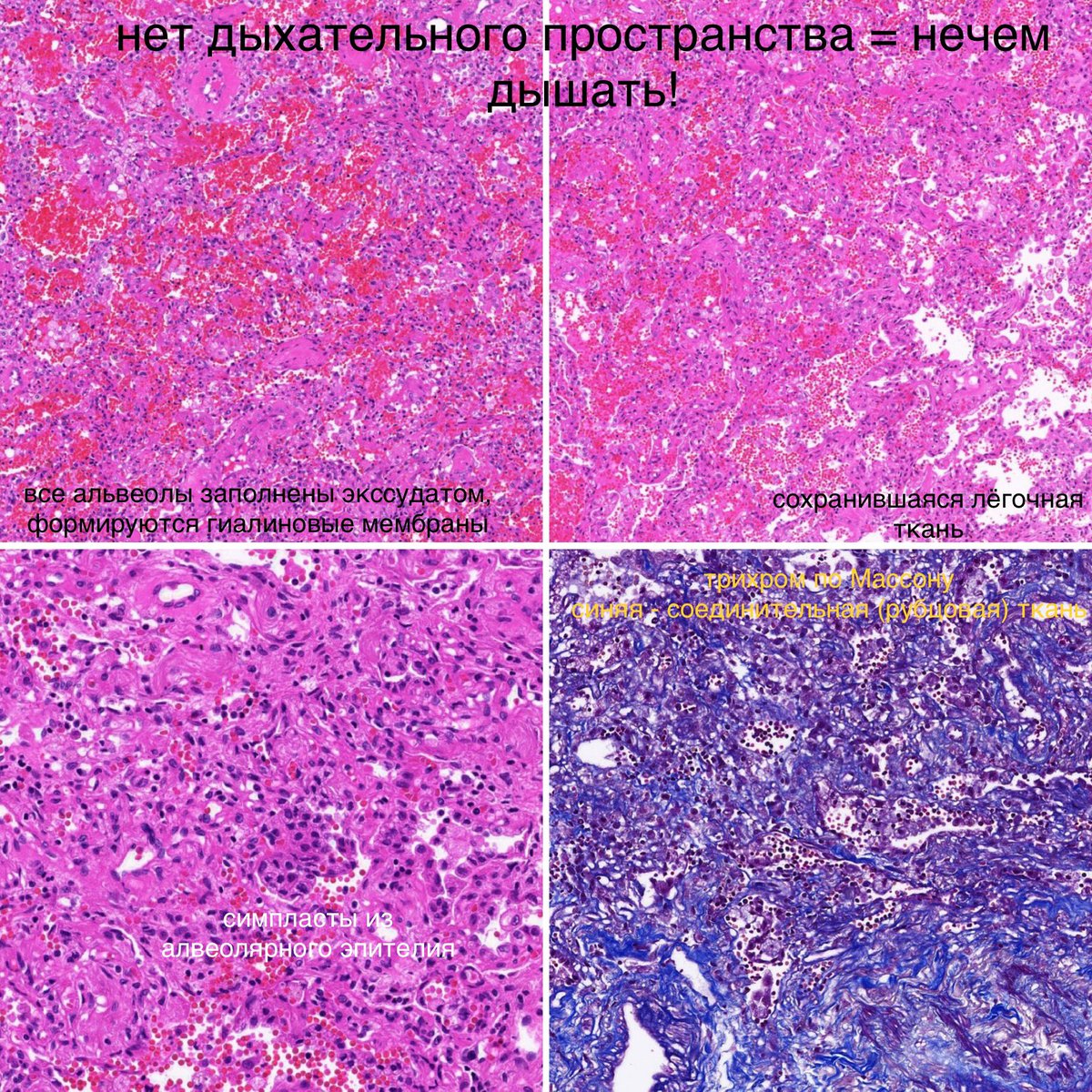 Вот как выглядит тот самый ОРДС при COVID на аутопсии. Альвеолы повреждены диффузно - т.е все сразу. При этом все они заполнены воспалительной жидкостью, т.е воздух физически не мог попадать через легкие в кровь даже если аппарат ИВЛ в легкие его и вдувал. https://twitter.com/sitovskaya/status/1244929387654533120