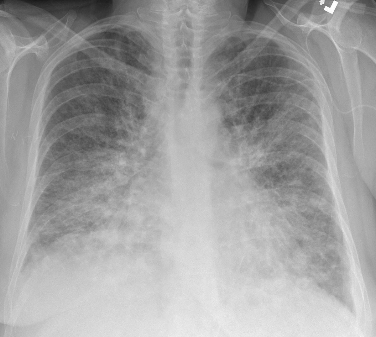 can you see emphysema on a chest x ray