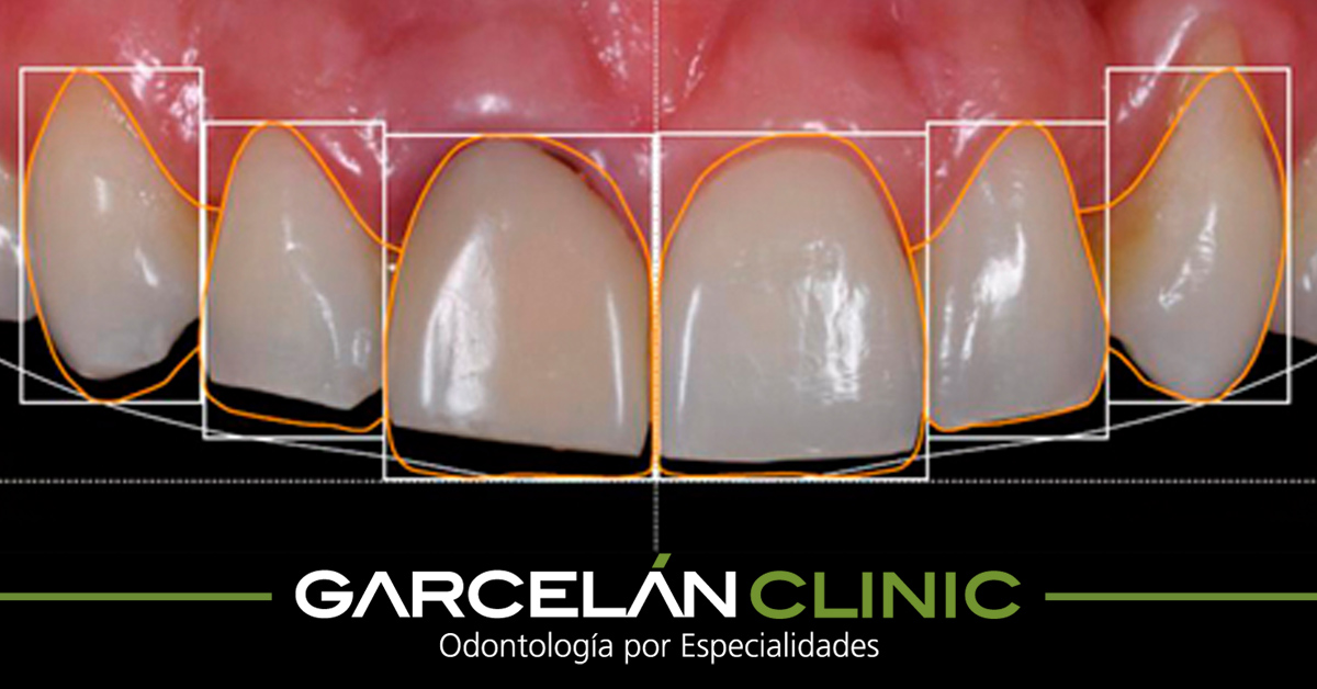 GarcelanClinic's tweet photo. ¿Cómo te verías con tu mejor sonrisa? En Garcelán Clinic no somos adivinos, pero contamos con la tecnología necesaria para realizar simulaciones muy cercanas a la realidad ;) https://t.co/z3aewVDenM https://t.co/o3BoxkdzDb