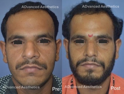 If a little bit of Aesthetic Surgery can improve your features permanently, why hesitate

A Broad nose, with deviation, hump and flared nostrils, corrected by Dr Ashish Davalbhakta.
.
.
#AestheticsMedispa #nosejob #nosesurgery #Rhinoplasty #cosmeticsurgery #permanent #noseshape
