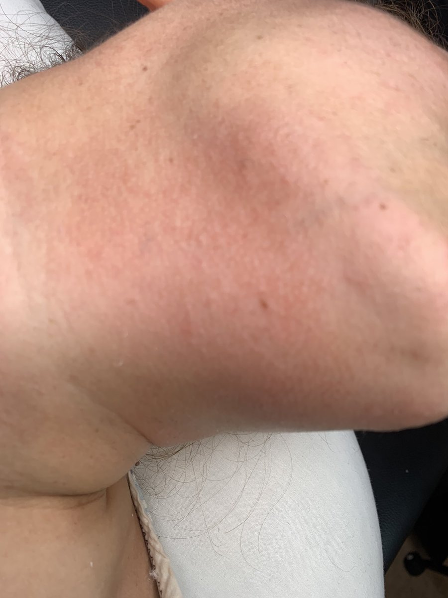 whosaskinggg's tweet photo. A Chin Wax I Did A Few Days Ago! ✨ #JenaeAdore #WaxIsLife #MDLashTech #DCLashTech #VALashTech #Facials #HybridLashes #VolumeLashes https://t.co/AmSJeqQpUP