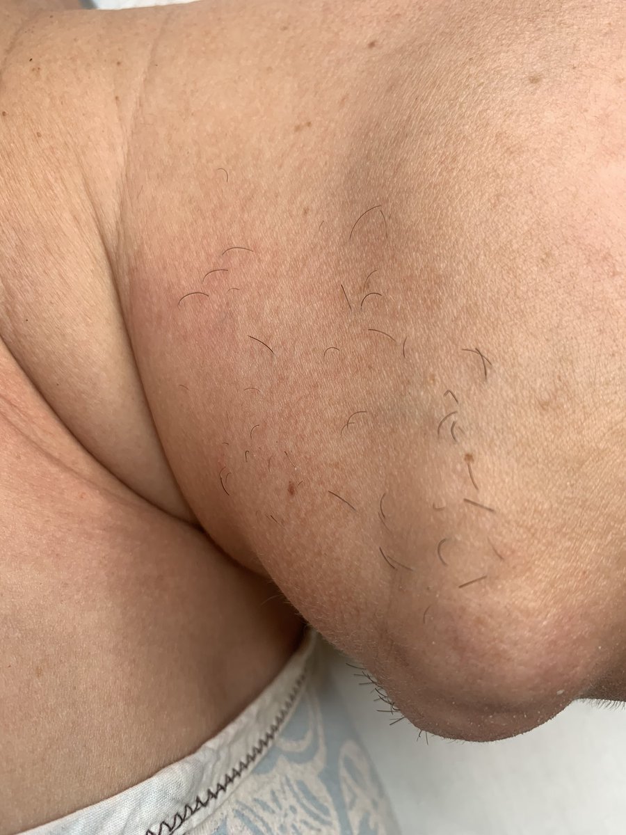 whosaskinggg's tweet photo. A Chin Wax I Did A Few Days Ago! ✨ #JenaeAdore #WaxIsLife #MDLashTech #DCLashTech #VALashTech #Facials #HybridLashes #VolumeLashes https://t.co/AmSJeqQpUP