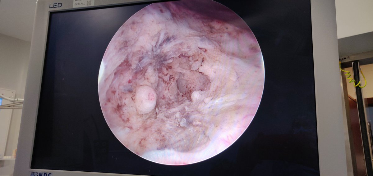 Resección profunda de tumor sésil vesical que cerraba el meato ureteral, URS libre de tumor uretral y colocación doble j.