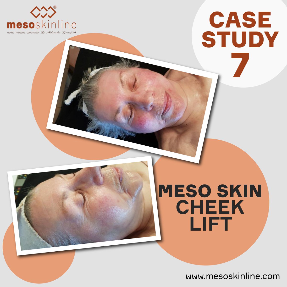 mesoskinline's tweet photo. Mesoskinline Cheek Lift
Case Study
My client is an 83-year-old female who has previously looked after her skin. Her skin is in good condition for her age.
Read More: https://t.co/Zidgnj9kUT
#skincare #antiaging #cheek #cheeklift #beauty #skin #skincareroutine #aesthetics https://t.co/JtgFyIlcoz