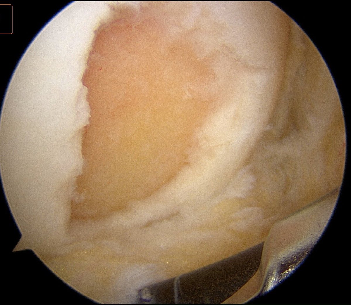 CzarneckiMD's tweet photo. This knee had chronic chondral defects (treated here with microfracture) w/ a new tear of the MM root which benefits from surgical stabilization to prevent arthritis. Rehab is delicate with 1 month non-weight bearing &amp; limited range of motion #meniscalrootrepair https://t.co/c2WeIN9Nrz
