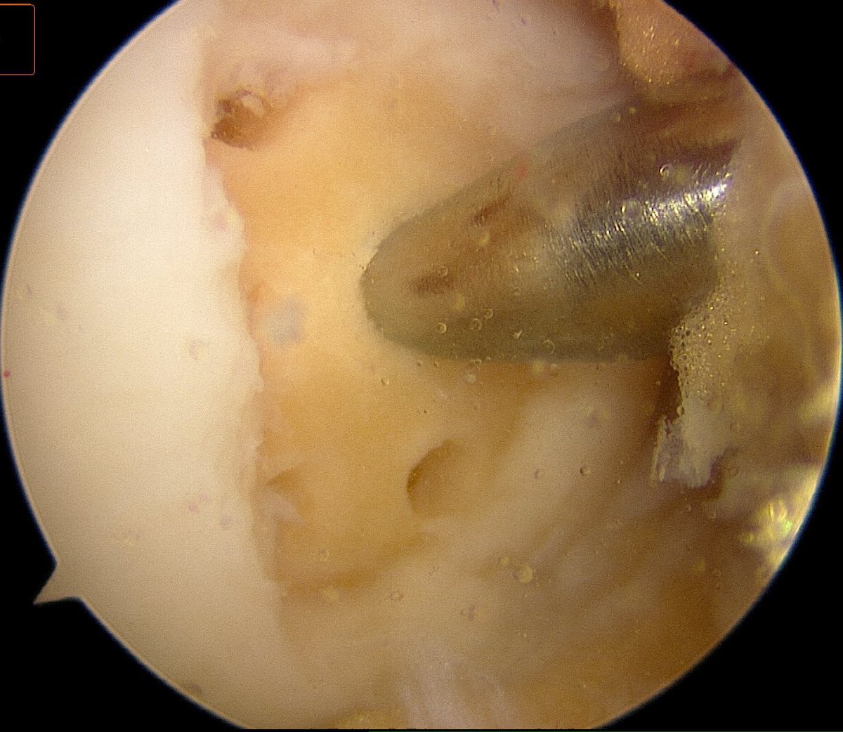CzarneckiMD's tweet photo. This knee had chronic chondral defects (treated here with microfracture) w/ a new tear of the MM root which benefits from surgical stabilization to prevent arthritis. Rehab is delicate with 1 month non-weight bearing &amp; limited range of motion #meniscalrootrepair https://t.co/c2WeIN9Nrz