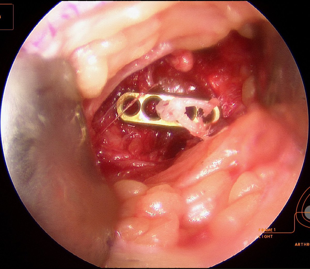 CzarneckiMD's tweet photo. This knee had chronic chondral defects (treated here with microfracture) w/ a new tear of the MM root which benefits from surgical stabilization to prevent arthritis. Rehab is delicate with 1 month non-weight bearing &amp; limited range of motion #meniscalrootrepair https://t.co/c2WeIN9Nrz