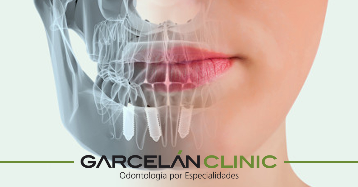 GarcelanClinic's tweet photo. Los dolores fuertes tras la colocación de #ImplantesDentales no son habituales, pero sí ciertas molestias o algo de inflamación. Puedes seguir estas recomendaciones para minimizarlos https://t.co/br4nNX8wR4 https://t.co/iK6VWH1zn7
