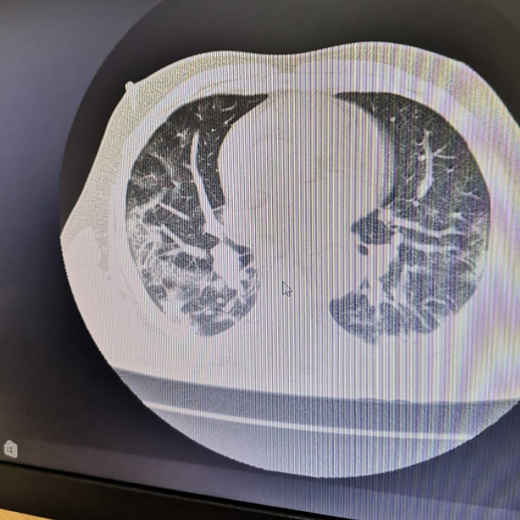 Tuve Disnea (falta de aire) y realice una TAC el Dr me obligó a ingresar x q las imágenes ya mostraban alteraciones, me realicé prueba en IESS ceibos y nunca llego el resultado, fui a ingresarme sola con miedo de no despedirme de mi familia pero lo q vi ahi me hizo correr