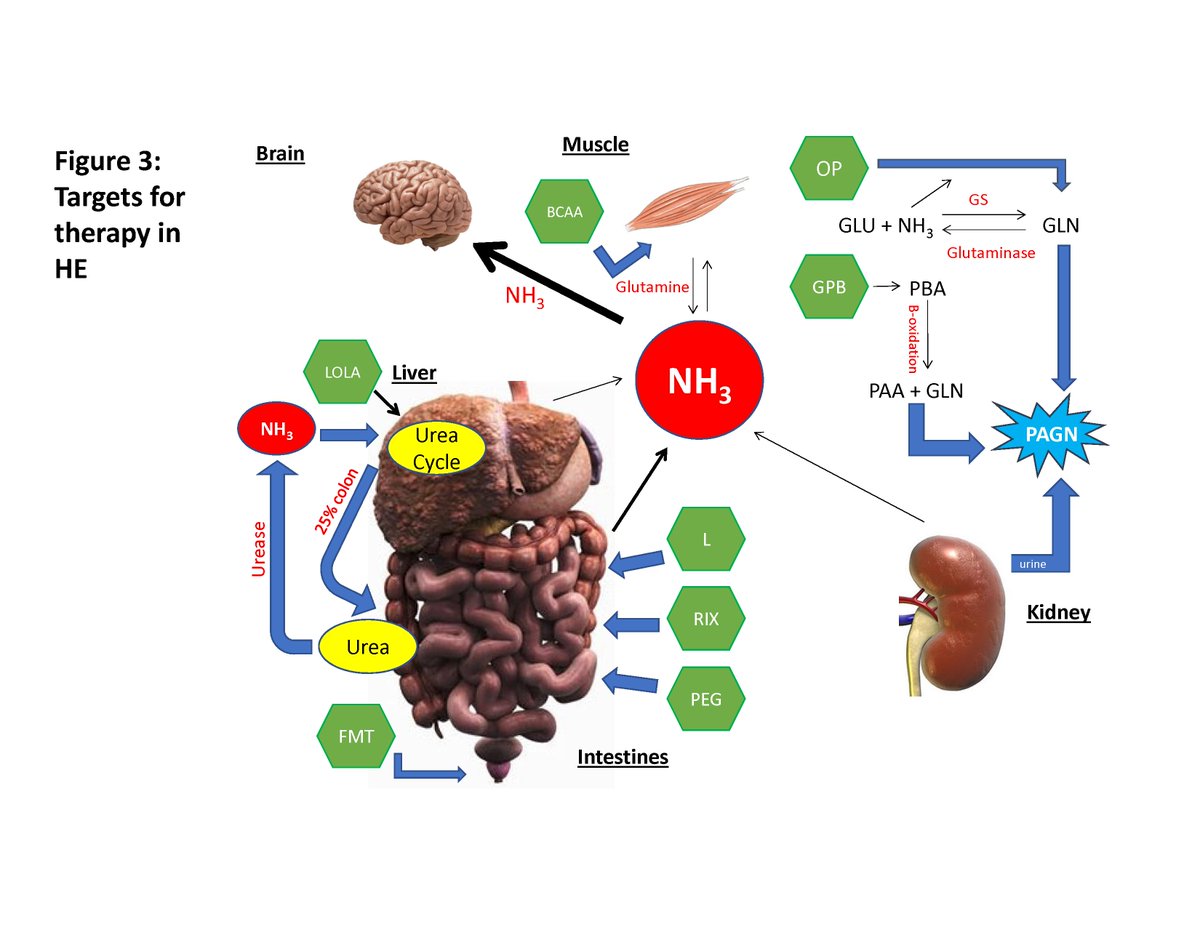 JasmohanBajaj's tweet photo. It's out! 5 unresolved questions in #hepaticencephalopathy
- Driving?
- Blood Ammonia levels?
- Covert/minimal HE testing?
- New HE therapies?
- Nutrition/Sarcopenia/PROs
Read the #ISHEN consensus in #AMJGastro
https://t.co/vLeteceDLq
@AmCollegeGastro @AASLDtweets Authors tagged https://t.co/QhZM6UBEjI