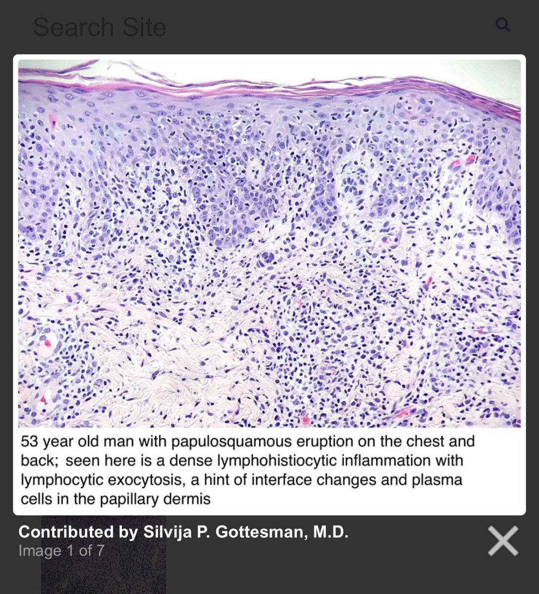 SGottesmanMD's tweet photo. .@Pathoutlines #Syphilis Page got a makeover by yours truly! Hope you enjoy! Updated text, new photos, sample path report + board style questions. Thank you for the honor! 🙏🏼🔬📚Link: https://t.co/ZHtVsPXYzl #dermpath #pathology #pathologists https://t.co/EbA3JA6cQv
