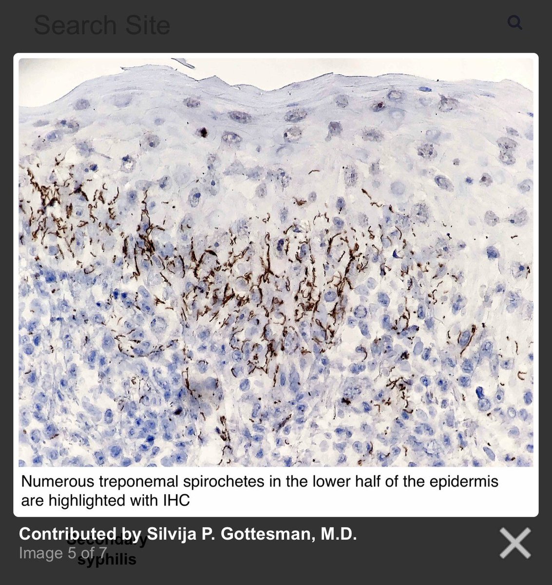 SGottesmanMD's tweet photo. .@Pathoutlines #Syphilis Page got a makeover by yours truly! Hope you enjoy! Updated text, new photos, sample path report + board style questions. Thank you for the honor! 🙏🏼🔬📚Link: https://t.co/ZHtVsPXYzl #dermpath #pathology #pathologists https://t.co/EbA3JA6cQv