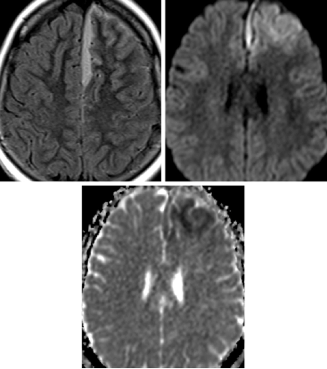 neurosurgatlas's tweet photo. For this week’s #triviatuesday #imagechallenge, take a look at the images above (FLAIR in the top row on the left, DWI in the top row on the right, and ADC bottom row) and take a guess at the pathology depicted here! Leave a comment below with your guess! https://t.co/gWaYAUCqLU