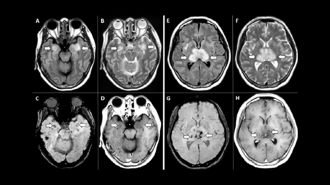 radiology_rsna's tweet photo. New research in @radiology_rsna reports the first presumptive case of #COVID19–associated acute necrotizing hemorrhagic encephalopathy, which has been associated with other viral infections, but yet to be demonstrated as a result of COVID-19. https://t.co/2L0dQxbxU4 #NeuroRad https://t.co/wjQq9BzAcy