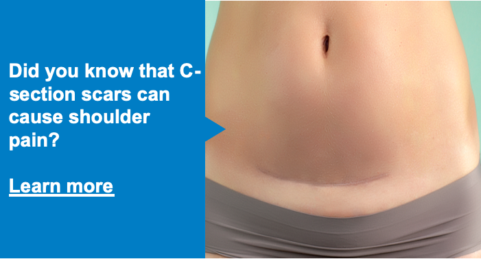 Dolphin_NS's tweet photo. Did you know that C-section scars can cause shoulder pain?
Learn more:
https://t.co/b84OXbAhDq
#DolphinMPS #PainRelief #PainFree #ChronicPain #ChronicPainRelief #NewMom #ShoulderPain #CSection #PressurePoints #WomensHealth https://t.co/Hs3tN7rUFj