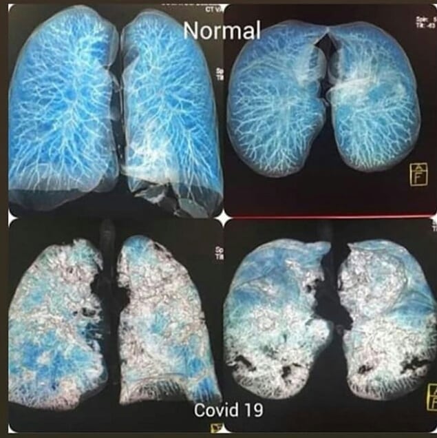 MiguelDlaCamara's tweet photo. Aquí ves dos cortes de TC (TAC o CTSCAN) en caso de #COVID19 

Son secciones a las que se les ha segmentado (extraído) todo el tejido vascular y cardiaco, y tráquea y bronquios. 

Es decir sólo ves pulmones. https://t.co/yM4aZbEb2J