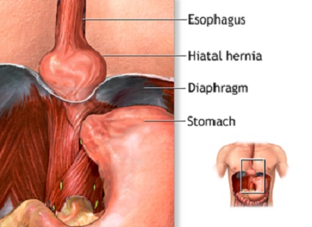 SL_GenSurgery's tweet photo. Know More about #InguinalHerniaSurgeryComplications | #USA
https://t.co/Gt1Ifd5odp
#HerniaCausesSymptomsAndTreatment #HerniaSurgeryAndRepairTexas #Surgeon #Surgery #Doctor  #healthcare #nurses #health #hospital #expert #patientsafety https://t.co/k5vhdvGWBc