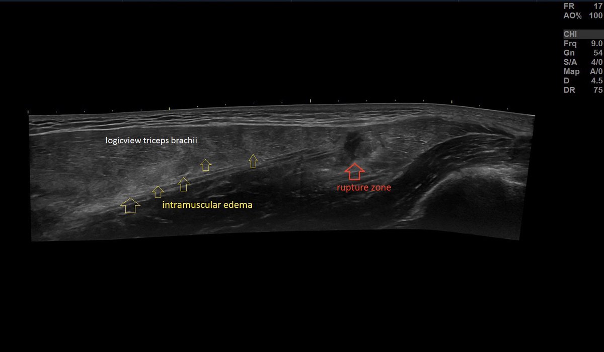 SportklinikBern's tweet photo. A very special workout 🏋️‍♀️ resulted in a #muscleinjury of the #tricepsbrachii —> #ultrasoundguidedinjection #arthrexacp #mskus #pocus #workoutinjury #logicview #s7r3 #gehealthcare Part 1 https://t.co/gRonN9GhXd