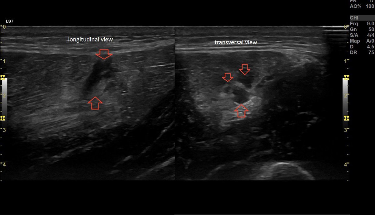SportklinikBern's tweet photo. A very special workout 🏋️‍♀️ resulted in a #muscleinjury of the #tricepsbrachii —> #ultrasoundguidedinjection #arthrexacp #mskus #pocus #workoutinjury #logicview #s7r3 #gehealthcare Part 1 https://t.co/gRonN9GhXd