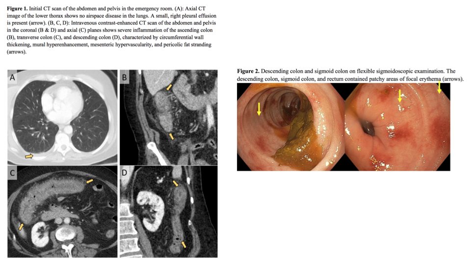BrennanSpiegel's tweet photo. ...patient had been in Egypt. But work-up negative. Only later, after days in hospital, was #COVID19 diagnosed. Then isolated and treated. Endoscopy revealed focal erythema (see pictures). Very important for GI doctors to read this case. Full pre-print: https://t.co/1UnugfRwgn https://t.co/25bBwA56l2