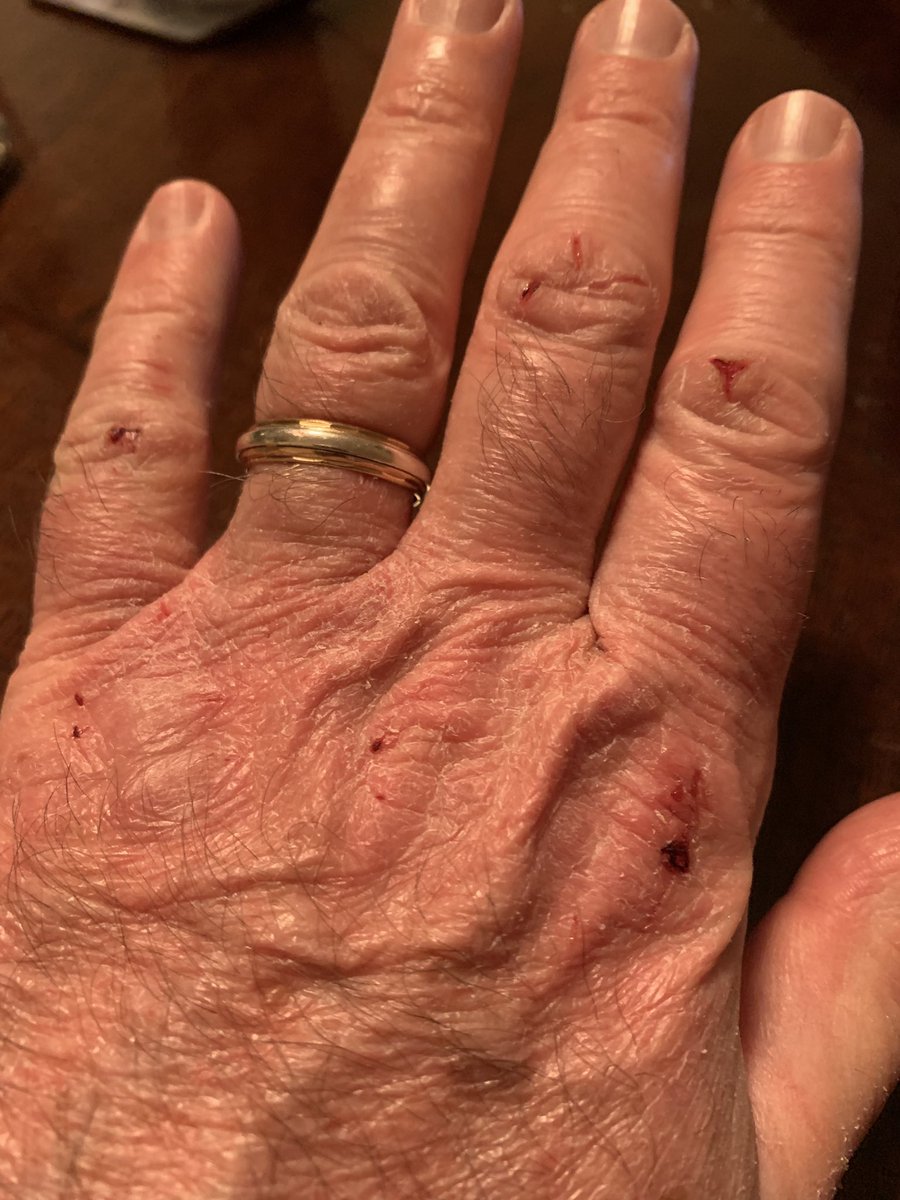 ProfJohnCrown's tweet photo. To the anonymous tweeter who accused me of hurling from the ditch-my hands after a day of approx 70x hand washes looking after approx 50 cancer patients an unknown number of whom have COVID. PS I’m 63- have a four year old. You-please stay at home now and be safe. https://t.co/uv2fcmYy08