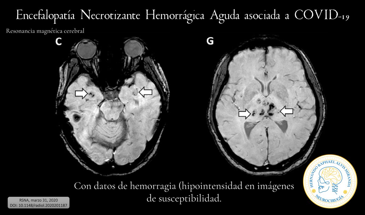 AlvisMD's tweet photo. Primer caso reportado de Encefalopatía Necrotizante Hemorrágica Aguda (ENHA) asociada a COVID-19.
F, 50s, trabaja en aerolínea, 3 días de fiebre, tos, y alteración del estado mental.
https://t.co/AjeKQwQKNo
#Neurology #Neurologia #Neurosurgery #Neurocirugia #COVID_19 https://t.co/ye8zy5XplY