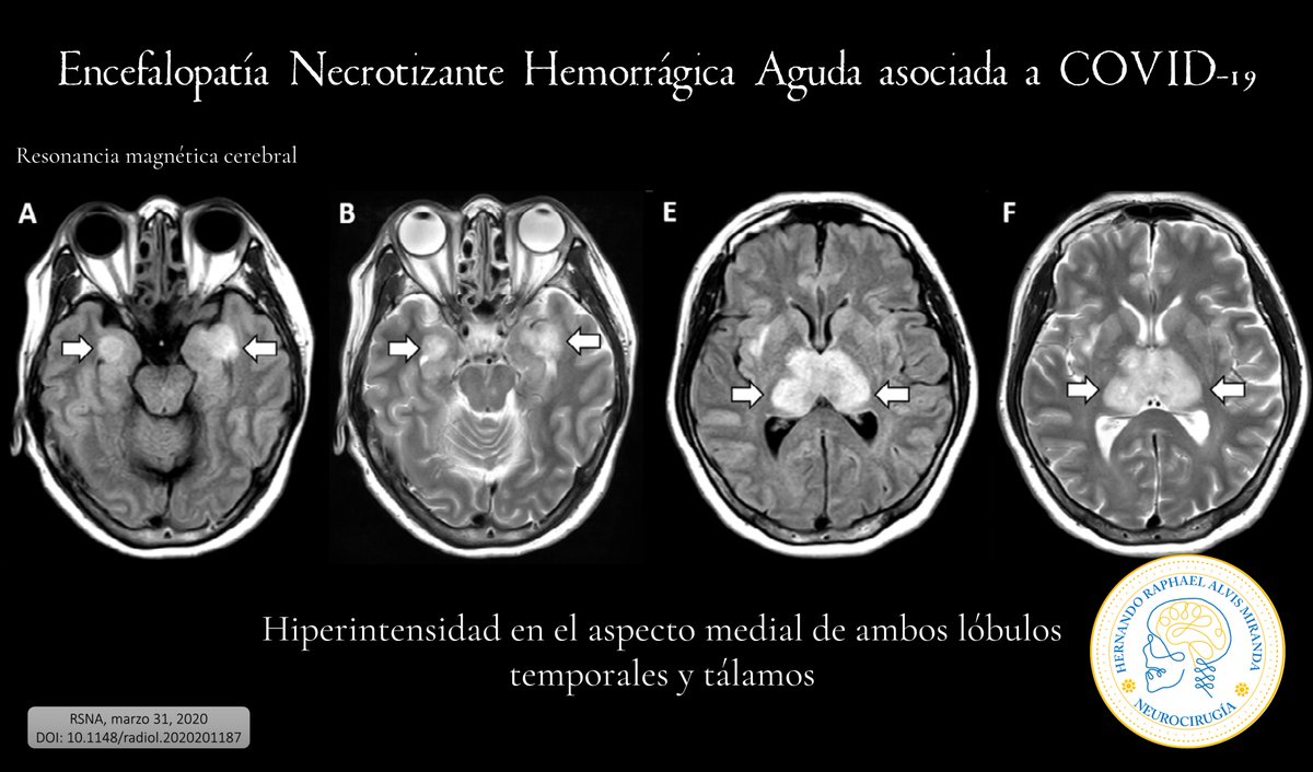 AlvisMD's tweet photo. Primer caso reportado de Encefalopatía Necrotizante Hemorrágica Aguda (ENHA) asociada a COVID-19.
F, 50s, trabaja en aerolínea, 3 días de fiebre, tos, y alteración del estado mental.
https://t.co/AjeKQwQKNo
#Neurology #Neurologia #Neurosurgery #Neurocirugia #COVID_19 https://t.co/ye8zy5XplY