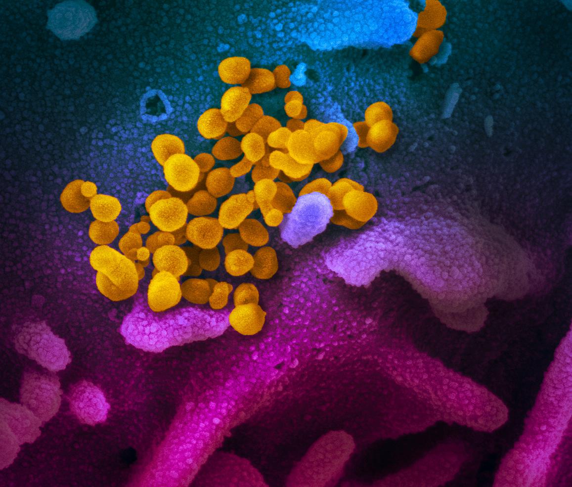 speciudea's tweet photo. Electron microscope image of SARS-CoV-2 (orange). NATIONAL INSTITUTE OF ALLERGY AND INFECTIOUS DISEASES https://t.co/ejNTdEipE6