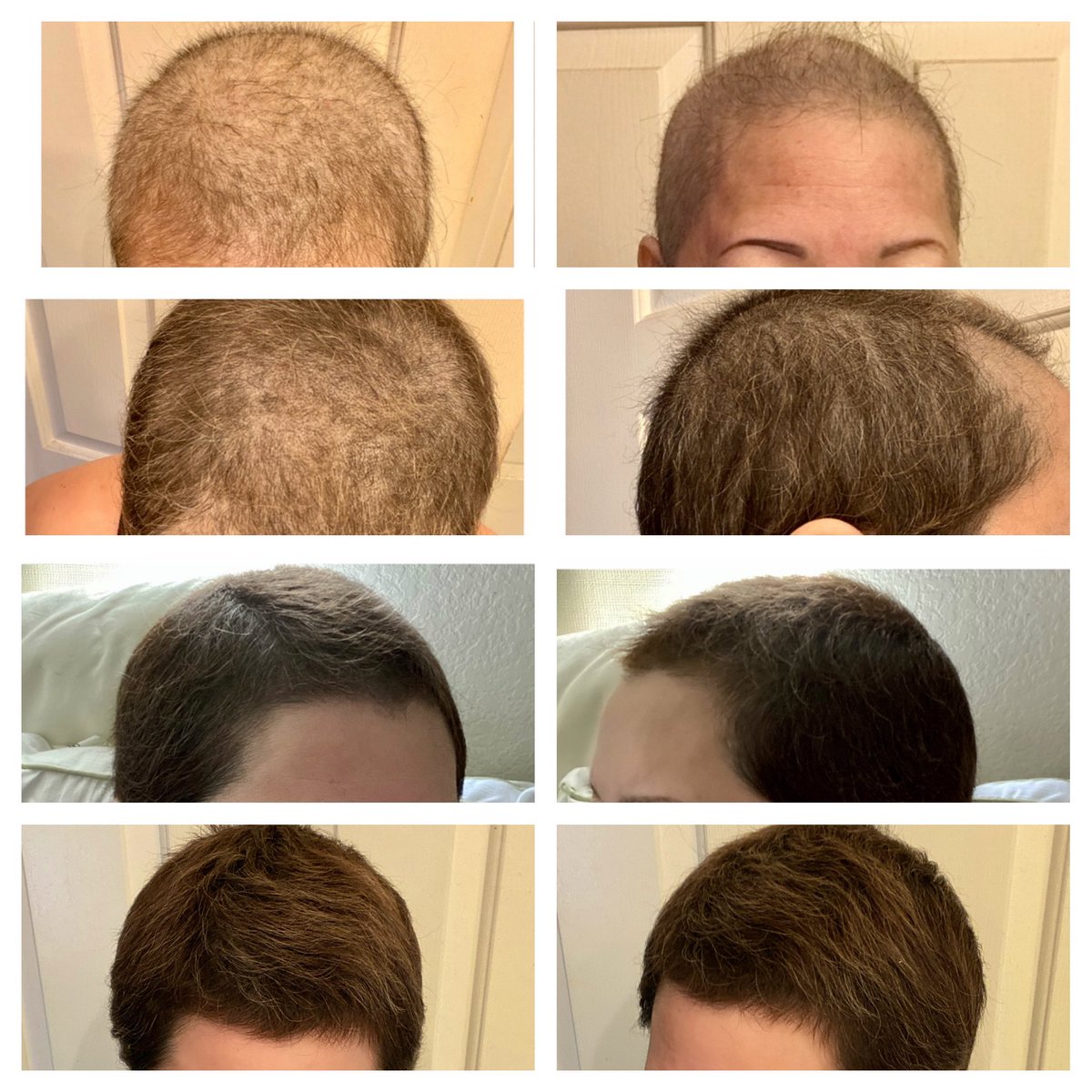 hair growth after chemo