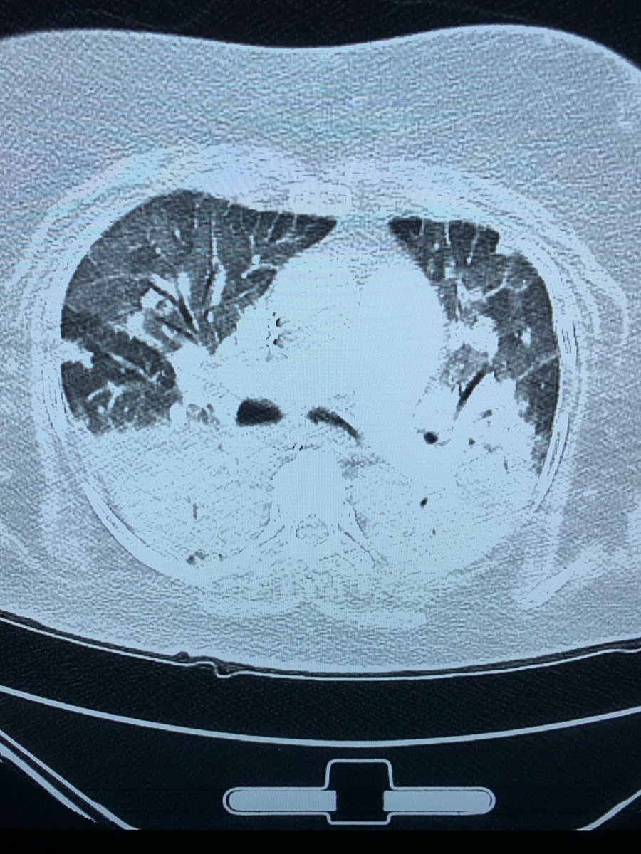 danortizmd's tweet photo. Case sent to me: 2 weeks post recovery from confirmed #covid19 rapid neurological decline. No prior neuro history. Working diagnosis DPHL secondary to prolonged hypoxia from COVID-19. #Neuroad, thoughts? https://t.co/QMwBY7tkBQ https://t.co/bBW8bQDkMu