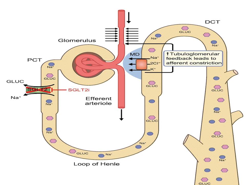 Now let’s find out what happens with SGLT2 inhibition With SGLT2 inhibition in PCT, Na/glucose, pass distally ↑ delivery of Na to macula densa vasoconstriction of afferent artery and Natriuresis and glycosuria