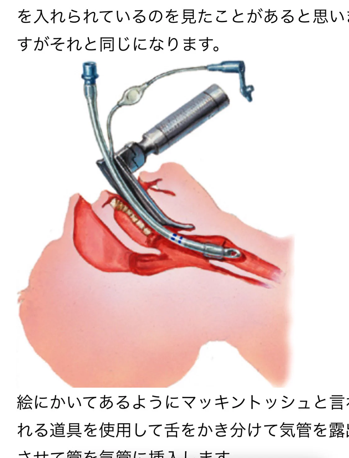 人工呼吸器を取り付ける時に使われる道具が怖い？すごい形してるwww