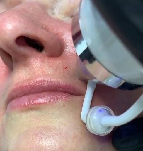 sinco_europe's tweet image. RF skin tightening beauty machine-Remove wrinkle and resist senility.

sincominimed.com/product
#beautymachine
#rfmachine
#skincaremachine