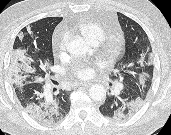 BSTImaging's tweet photo. We have now updated the #BSTI #Covid19database.
≈50 good quality cases available on the teaching portal. More cases in the database.
CT scrolling in diagnostic quality with available clinical parameters
Upload and view cases: https://t.co/1M1om8bcXj https://t.co/Gt9qZepbUg
