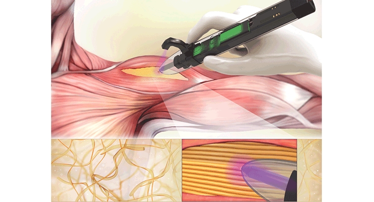 SamISureAm's tweet photo. #Bioprinting pen deposits materials to support cell and tissue growth into defect sites associated with weakened skeletal muscles. #orthopedics @UConn @lab_limb | https://t.co/RslOI8wxYE https://t.co/LiZRrq9nNk